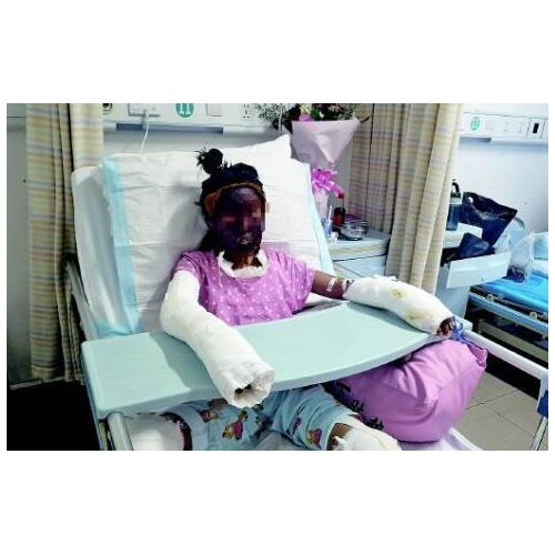 模仿网红用酒精做爆米花 枣庄俩女孩烧伤一人重度烧伤